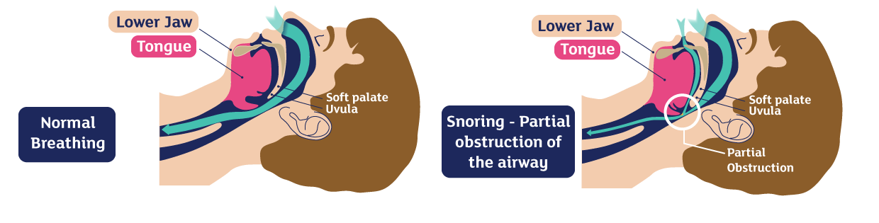 Diagram of why we snore
